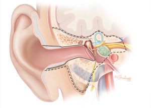 Temporal bone resection for malignancy encompasses three related procedures of progressively increasing depth: sleeve resection of the external auditory canal (solid line), lateral temporal bone resection (dotted line), and total temporal bone resection (dashed line). The illustration depicts these procedures in the coronal view. Most of these resections are performed for squamous cell carcinoma arising from the external auditory canal. It is generally acknowledged that sleeve resection is an insufficient therapy for malignant disease. In the lateral temporal bone resection, the ear canal is removed en bloc with the tympanic membrane and lateral ossicles. A parotidectomy and/or neck dissection often supplements the temporal bone specimen. In total temporal bone resection, creation of an en bloc specimen is difficult and probably unnecessary. It requires an extensive dissection of the intrapetrous carotid artery, a measure usually of little benefit in deeply invasive squamous cell carcinoma. Most contemporary otologists perform the so-called total temporal bone resection by first carrying out a lateral temporal bone resection and then removing the medial petrous bone piecemeal with a drill. This procedure is indicated for deep extension which penetrates beyond the medial wall of the middle ear and/or mastoid.