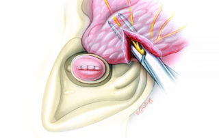 When the anterior aspect of the ear canal is involved by tumor, it is often appropriate to remove a cuff of tissue anteriorly. This includes part or all of the parotid gland and the tissue which resides between the ear canal and mandibular condyle. Parotidectomy is commenced by identification of the facial nerve as it exits the stylomastoid foramen. In the absence of gross tumor involvement of the parotid region, then only the portion of the gland which abuts the ear canal needs to be removed. In such cases, only the part of the parotid which lies posterior to the upper branch of the facial nerve must be included with the specimen.
