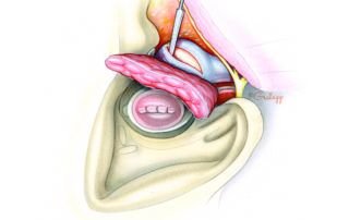 Once the parotid has been reflected posteriorly, the mandibular condyle is addressed. There are three options for handling the condyle: taking only its capsule, partial resection, and complete resection. When leaving the condyle in situ, an incision is made in its capsule with cutting electrocautery.