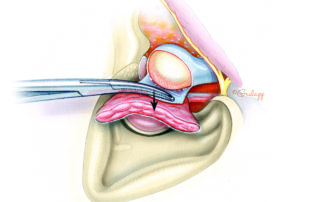 The capsule is then dissected off the condylar head.