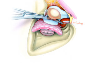 The leathery condylar capsule is transected on the deep side with Mayo scissors. The superficial temporal artery and vein need to be controlled at this point.