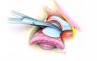 Partial condylectomy can be accomplished with a drill, leaving intact a portion of the articular face of the joint. This maneuver facilitates removal of a wider cuff of soft tissue anterior to the deep portion of the ear canal. Complete condylectomy is accomplished by treading a Gigli saw around the condylar neck. While isolating the condylar neck, care must be taken to avoid injury to the internal maxillary artery.