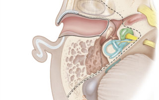 Axial view of the three types of temporal bone resection for malignancy: sleeve resection of the external auditory canal (solid line), lateral temporal bone resection (dotted line), total temporal bone resection (dashed line).
