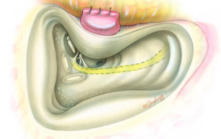 After transection of the cartilaginous canal just medial to the meatus, a ring of skin and cartilage is harvested from the specimen side and sent for frozen section analysis. If tumor is seen in the specimen (uncommon), then further resection of the meatus and pinna is performed as necessary. To discourage spillage of tumor cells, the meatus is sewn shut. An intact canal wall mastoidectomy is then performed with opening of the facial recess (for technique, see 7.5 Facial Recess Approach). FR, facial recess.