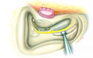 The descending portion of the fallopian canal is then skeletonized, leaving a thin bony covering. Identification of the position of the facial nerve is important for the next step during which the facial recess opening is then extended inferiorly into the hypotympanum.