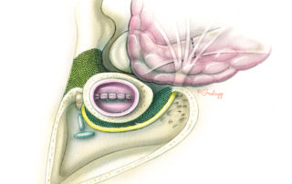 To isolate the ear canal as an en bloc specimen, bone must be removed from 360 degrees around the canal (green stippled area). An extended facial recess approach is connected to the posterior and inferior aspects of the middle ear. The anterior wall of the mastoid is removed between the inferior margin of the osseous ear canal and the stylomastoid foramen. Superiorly, the root of the zygoma and the posterior aspect of the glenoid fossa are removed (yellow stippled area).