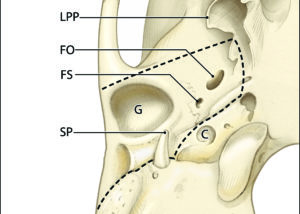 Osseous anatomy of the lateral skull base as seen from below illustrating the resection limits of the infratemporal fossa extension of temporal bone resection (dotted line). LPP, lateral pterygoid process; FO, foramen ovale; FS, foramen spinosum; G, glenoid fossa; SP, styloid process; C, carotid canal.
