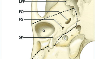 Osseous anatomy of the lateral skull base as seen from below illustrating the resection limits of the infratemporal fossa extension of temporal bone resection (dotted line). LPP, lateral pterygoid process; FO, foramen ovale; FS, foramen spinosum; G, glenoid fossa; SP, styloid process; C, carotid canal.