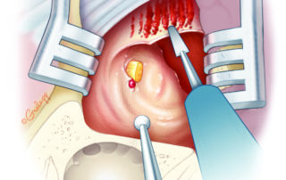 Resection of pterygoid muscle is completed to the level of the lateral pterygoid plate. A diamond burr is used to excavate a bony margin on the anterior surface of the petrous bone. The middle meningeal artery and third division of the trigeminal nerve lie transected where they traverse the middle fossa floor.