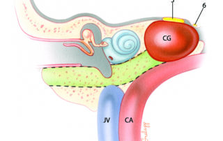 The petrous apex is the medial portion of the petrous bone that lies between the inner ear and the clivus. Petrous “apicectomy” is the term commonly applied to a procedure which reaches the apical portion of the petrous bone by skirting around the inner ear. It is inherently a drainage procedure which creates only a relatively small entry into the apical region. Thus, the commonly used term petrous “apicectomy” is a misnomer when used in this context. Petrous apicotomy would actually be a more accurate description for the procedure. Petrous apicotomy is primarily indicated for drainage of cholesterol granuloma and purulent infections. Fundamentally, there are two routes used to reach the petrous apex: those which pass near the labyrinth and those which skirt the cochlea. In recent years, the hypotympanic–subcochlear route depicted here has become the most popular. The bone removed during this procedure is depicted in this schematic coronal illustration as the color green. Note the relationship of the apical cholesterol granuloma to the fifth and sixth nerves. This explains the frequent occurrence of deep ear and retro-orbital pain as well as diplopia in these lesions. JV, jugular vein; CA, carotid artery; CG, cholesterol granuloma; 5, trigeminal nerve; 6, abducens nerve.