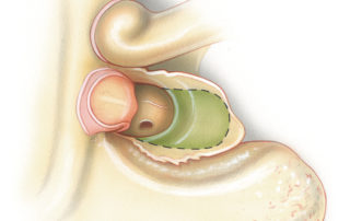 The tympanic bone showing the bone removed (green) on route to the petrous apex.