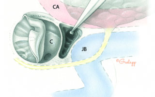 In the subcochlear approach, the petrous apex, bone is excavated from the triangle bounded by the cochlea (C) superiorly, the jugular bulb (JB) posteriorly, and the carotid artery (CA) anteriorly.
