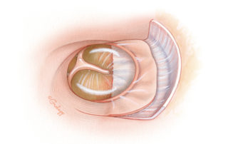 After drainage of the cyst, the infracochlear opening remains open and is marsupialized into the tympanic cavity. As the tympanomeatal flap is now too short to cover the hypotympanic defect, it is augmented with a temporalis fascia graft. Once healing has taken place, the otoscopic appearance is of an enlarged tympanic membrane.