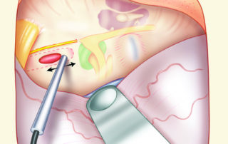 The intrapetrous carotid artery may be congenitally dehiscent on the middle fossa floor or may have been eroded by disease. A Doppler probe may be useful in identifying the carotid before making an incision in the roof of the cholesterol granuloma.