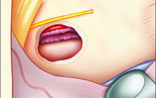 If the cyst membrane is adherent to a dehiscent vessel wall, a portion of the cyst capsule is left on the carotid artery to avoid possible vascular injury with resultant stroke.