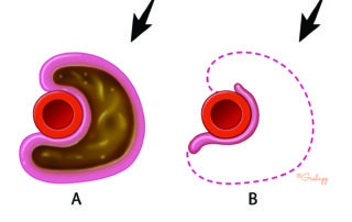 Sagittal schematic illustration of the relationship between a petrous apex cholesterol granuloma and the intrapetrous carotid (a). When the cyst wall adheres to the carotid wall, it may be wisest to leave the adherent portion (b). The arrow represents the surgeon’s point of view.