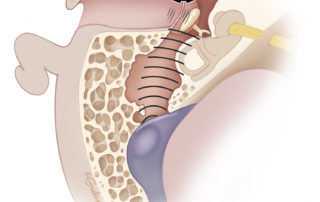 Flow in the venous sinuses is rapid and under high pressure. When the bony covering of the sigmoid sinus is dehiscent, sound generated may pass via the mastoid air cells to the tympanum with it and can vibrate the tympano-ossicular chain resulting in pulsatile tinnitus. This is the most common cause of troubling pulsatile tinnitus.