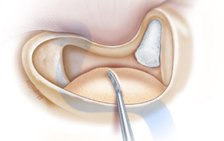 Covering of the dehiscent sinus with a thick coating of hydroxyapatite cement to create a sound baffle. This has proved highly effective in abating pulsatile tinnitus in properly selected patients. Note the temporary placement of absorbable gelatin sponge in the aditus-ad-antrum to protect the ossicles from coming in contact with the cement.