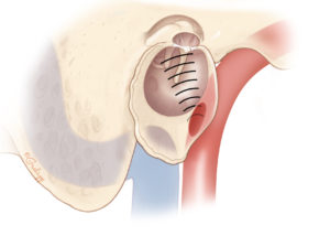Dehiscent jugular bulb into the hypotympanum may result in pulsatile tinnitus.