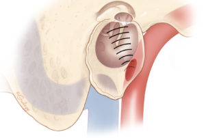 Dehiscent jugular bulb into the hypotympanum may result in pulsatile tinnitus.