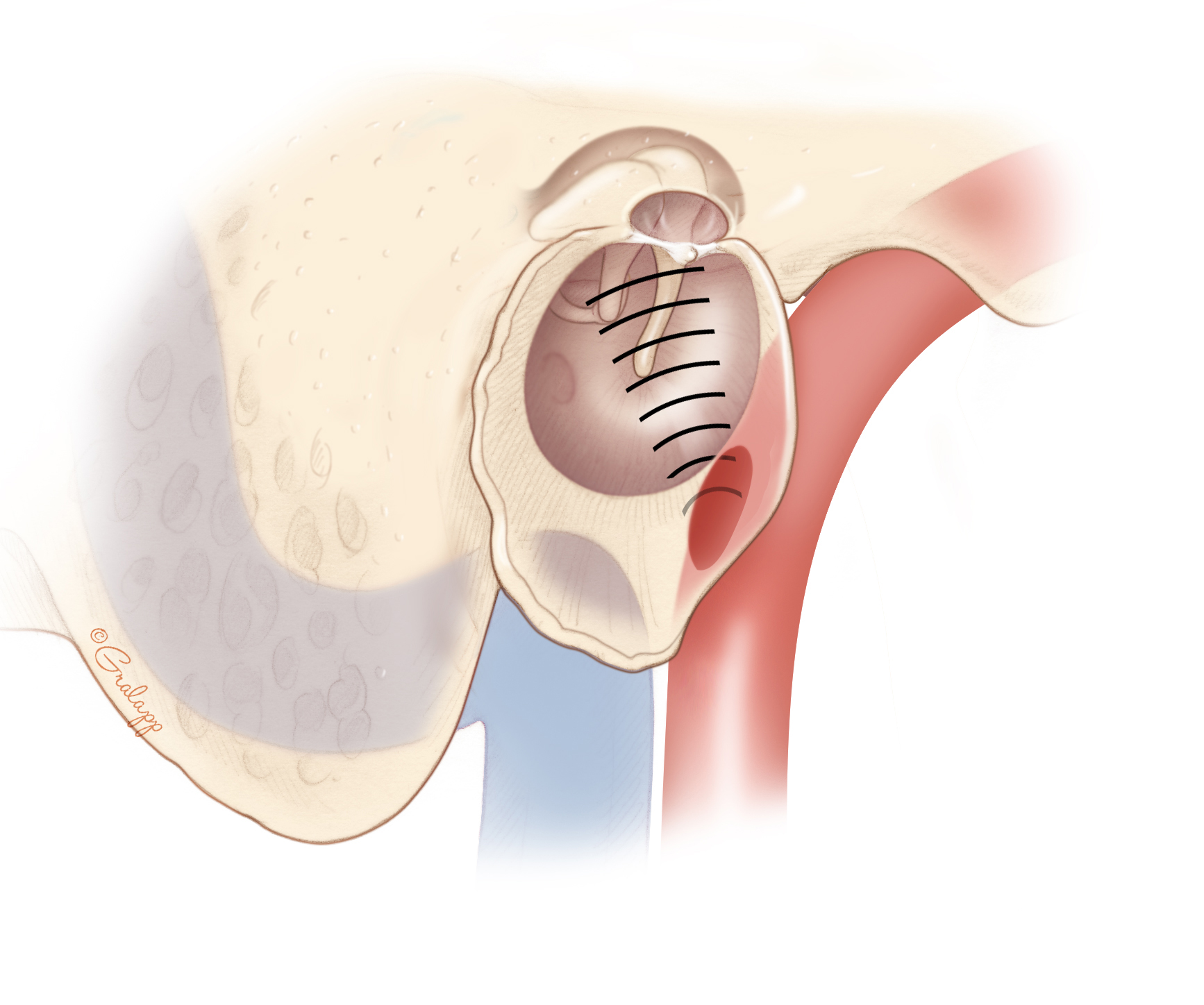 Pulsatile Tinnitus of Carotid and Jugular Bulb Origin – Oto Surgery Atlas