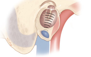 Dehiscent carotid artery into the hypotympanum may result in pulsatile tinnitus.
