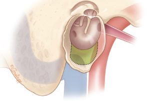 Hypotympanic approach for exposure of the great vessels. This procedure is done postauricularly with lowering of the floor of the osseous ear canal in preparation.