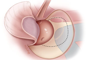 A superiorly based tympanomeatal flap is elevated.