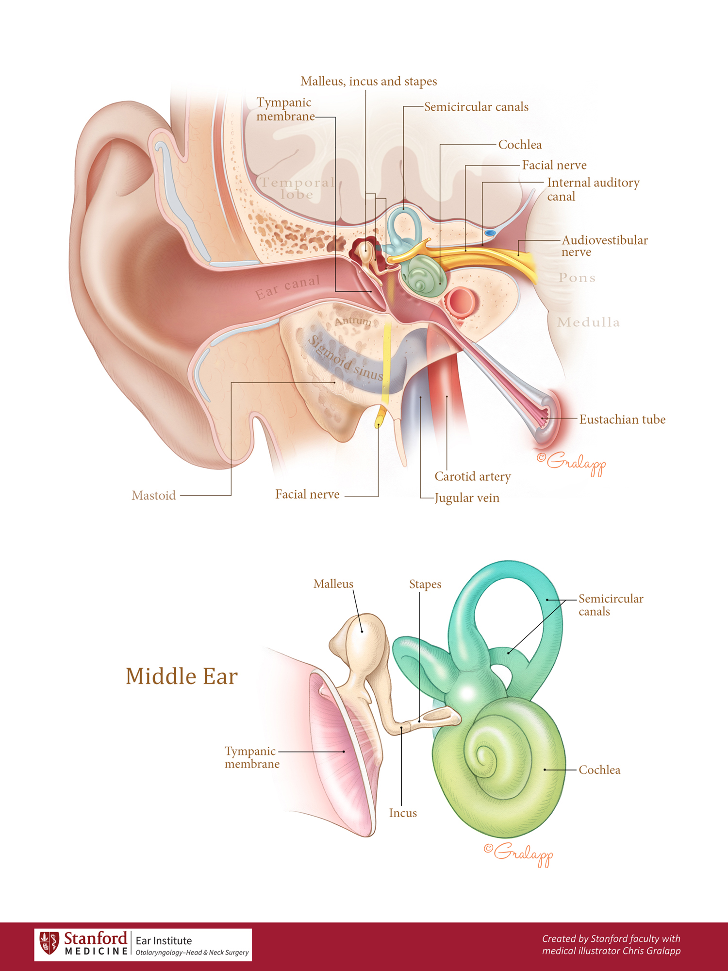 Tympanosclerosis – Oto Surgery Atlas