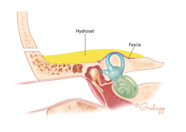 Appendix: Educational Handouts for Patients – Oto Surgery Atlas