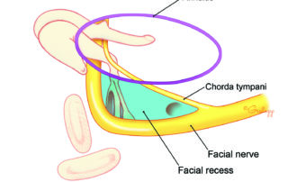 Facial recess (blue): surgical path to middle ear via the mastoid.