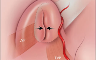 Eustachian tube closed. LVP, levator veli palatini; TVP, tensor veli palatini.