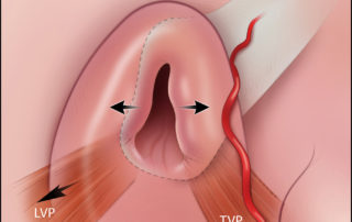 Eustachian tube opening mechanism driven by the tensor and levator muscles.