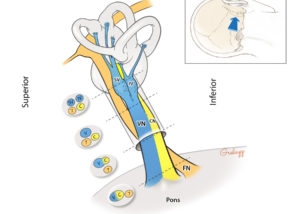 Anatomy of the nerves traversing the internal auditory canal as seen from a retrosigmoid craniotomy perspective. Note the 90-degree rotation of the vestibular and cochlear nerve components of the eighth nerve between inner ear and brainstem entry. C, cochlear nerve; CN, cochlear nerve; IV, inferior vestibular nerve; VN, vestibular nerve; SV, superior vestibular nerve; 7, facial nerve.