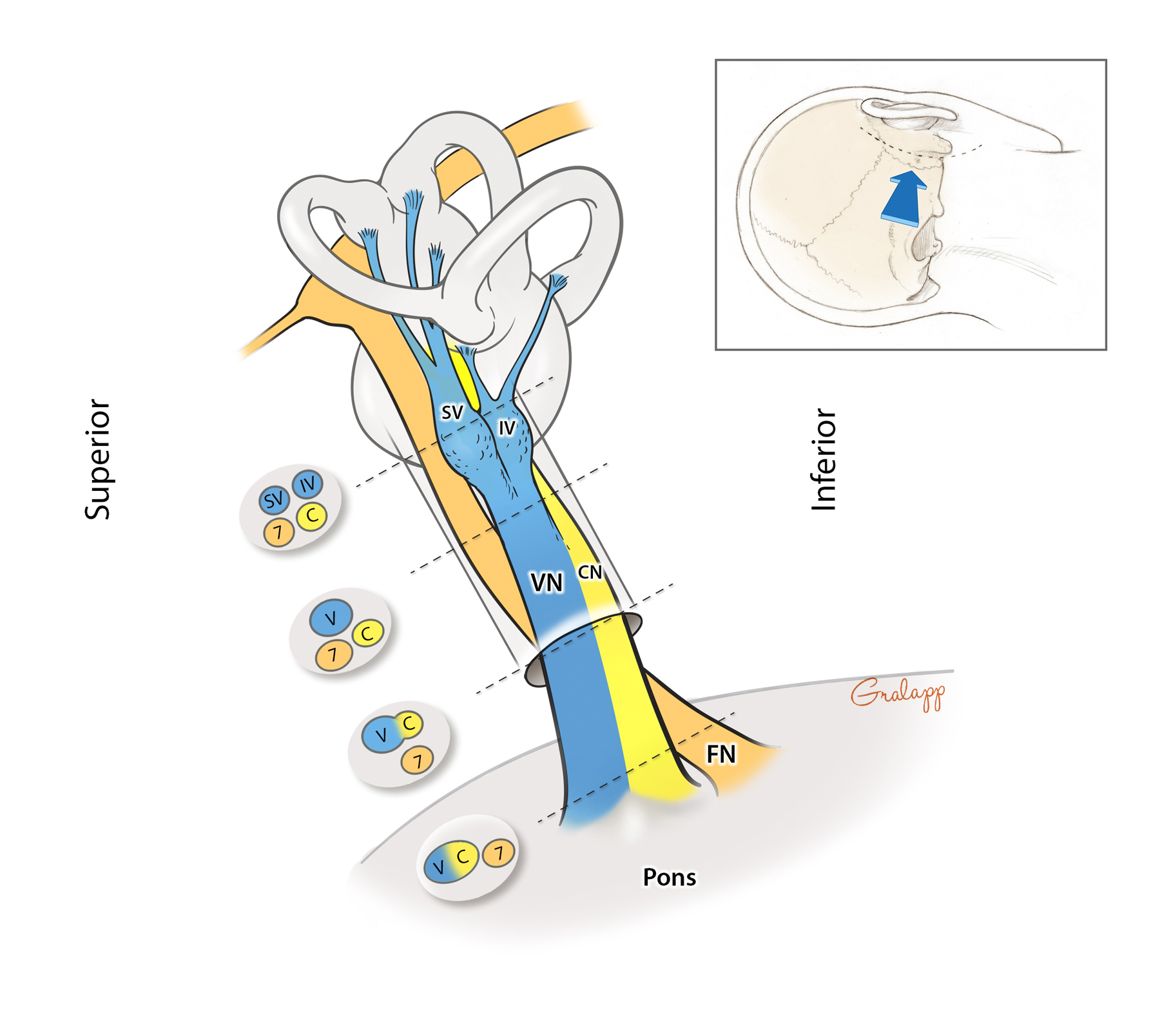 2 mm enhancing nodule in internal auditory canal