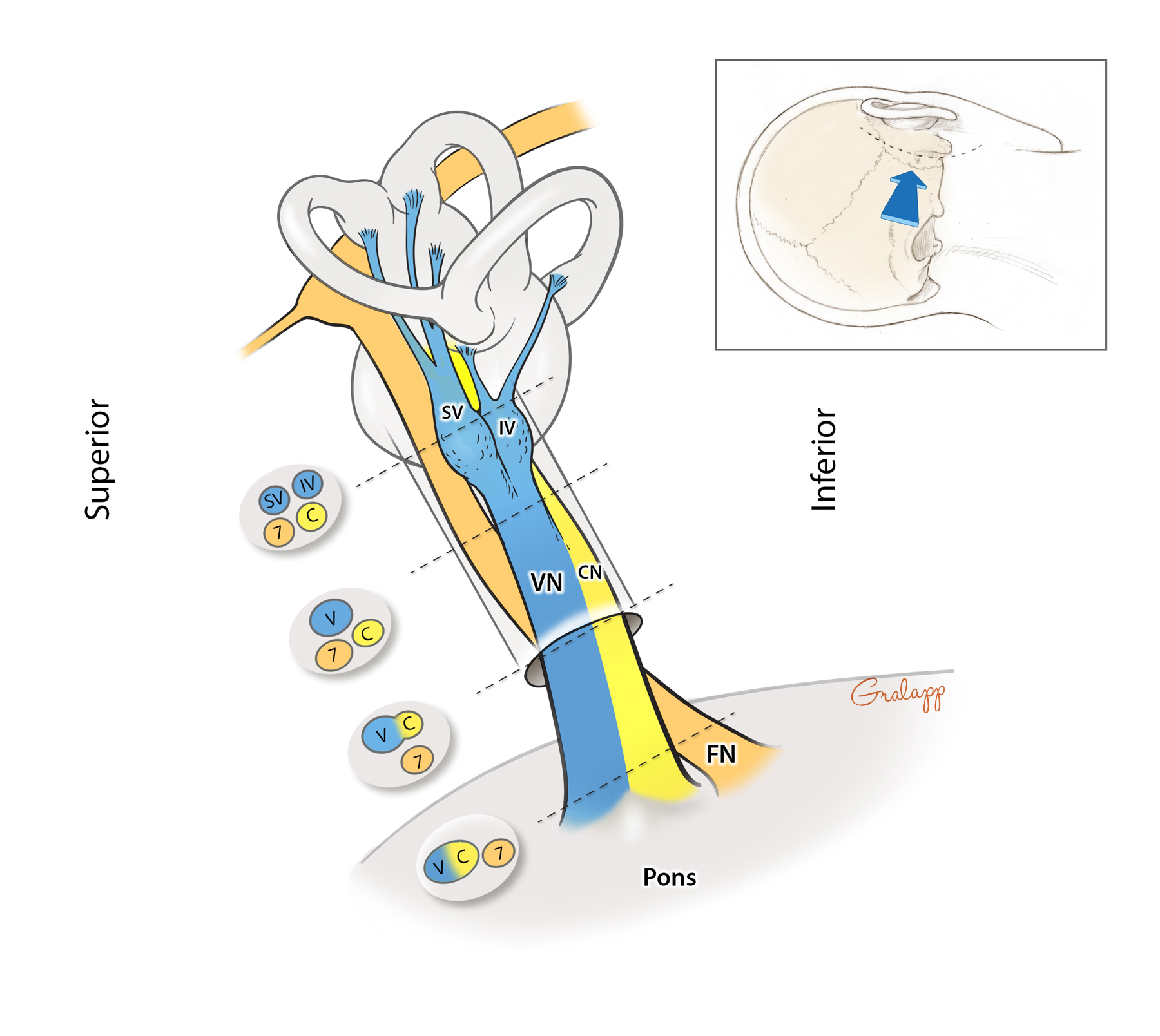 cpt code decompression internal auditory canal