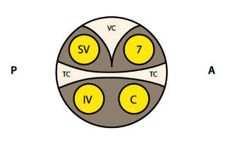 At the lateral extremity of the IAC the relationships of the superior vestibular (SV), inferior vestibular (IV), facial (7), and cochlear (C) nerves are highly predictable. In this location, the canal is completely divided in the horizontal plane by the transverse crest (TC) and its upper compartment is partitioned by a vertical bony crest (VC) also known as Bill’s bar (after William F. House, MD). A, anterior; I, inferior; P, posterior; S, superior.