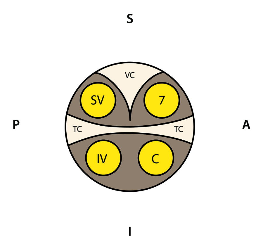 internal-auditory-canal-and-cerebellopontine-angle-oto-surgery-atlas