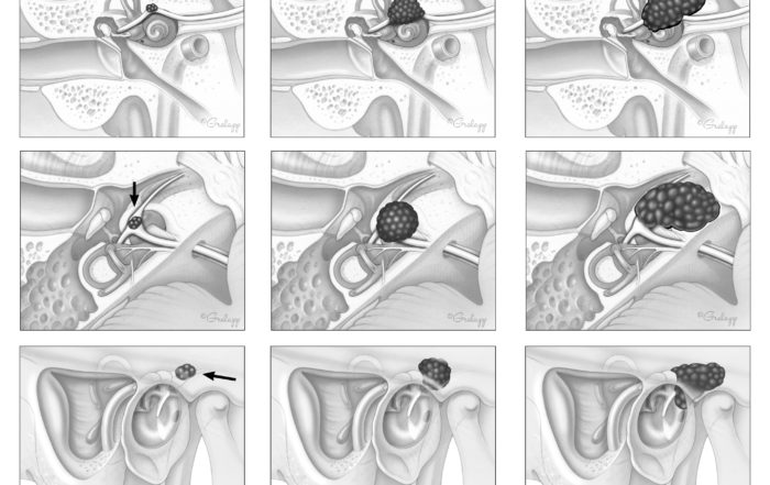Ear Tumor Anatomy – Oto Surgery Atlas