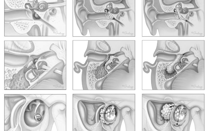 Red Mass In Ear Ear Tumor Anatomy – Oto Surgery Atlas