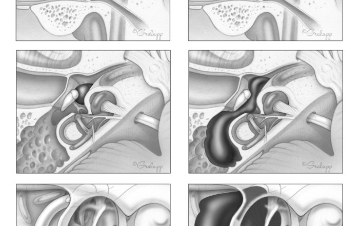 Ear Tumor Anatomy – Oto Surgery Atlas