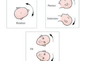The three variables for positioning of the head in ear microsurgery: rotation, tilt, and flexion–extension.