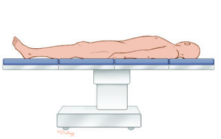 Table positioning for stapes surgery to optimally view the posterior superior quadrant of the middle ear. This is the starting point.