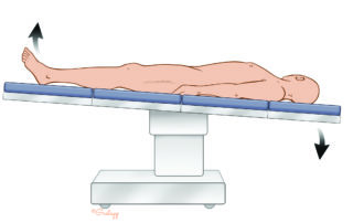 Table positioning for stapes surgery: slight Trendelenburg (head down).