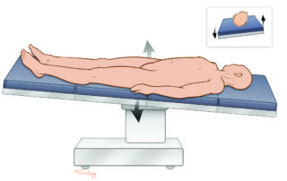 Table positioning for stapes surgery: slight rotation toward the surgeon to optimize angle to the posterior–superior quadrant.