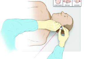 Incorrect positioning with the head under rotated, extended, and tilted. This forces the surgeon to operate at an awkward angle, in the case depicted with the arm on the patient’s thorax.