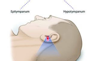When the patient is positioned well, the surgeon should be able to gaze from the epitympanum to hypotympanum. Suboptimal patient positioning contributes to neck and lower back problems endemic among otologic surgeons.