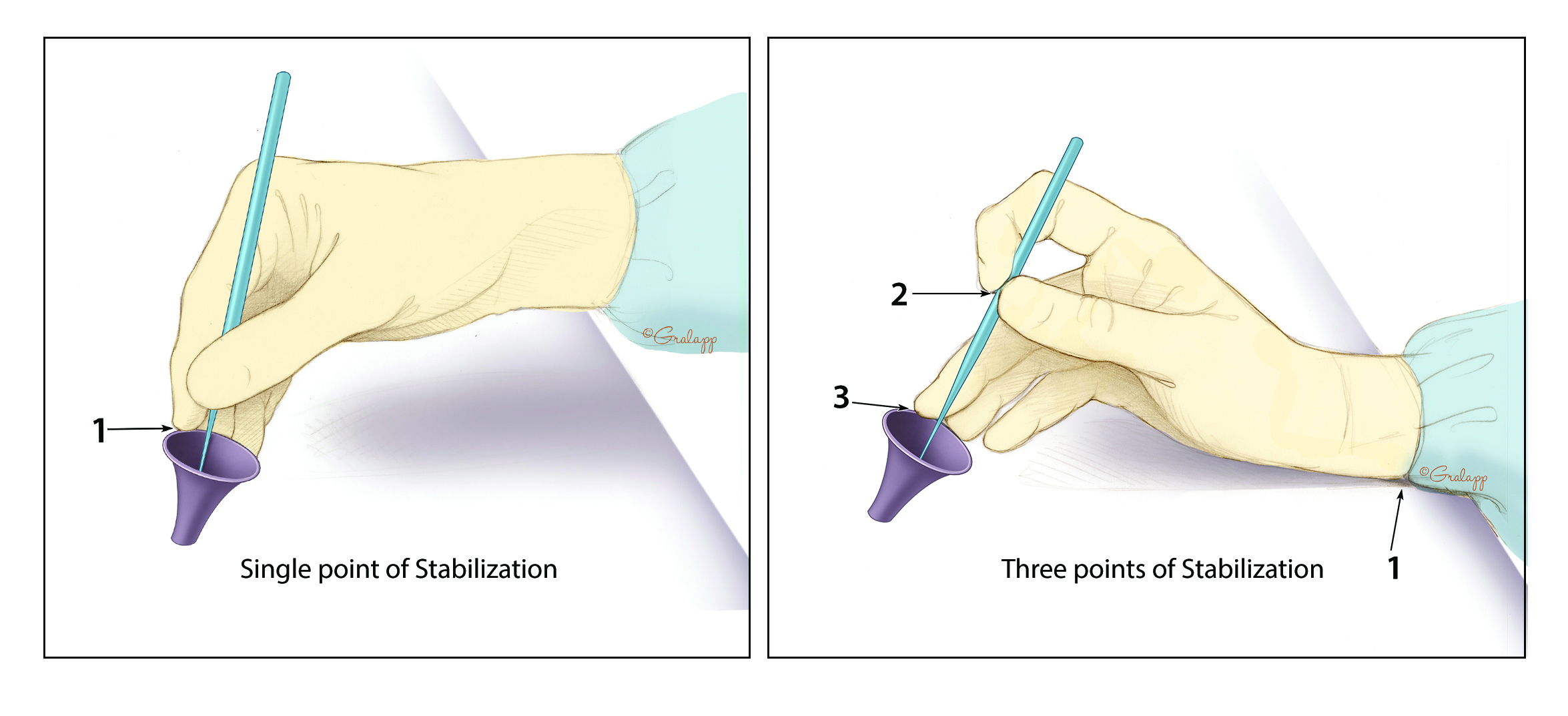 Incorrect hand position for ear microsurgery, which is less stable and limits visibility. The correct hand position has three-point stabilization.