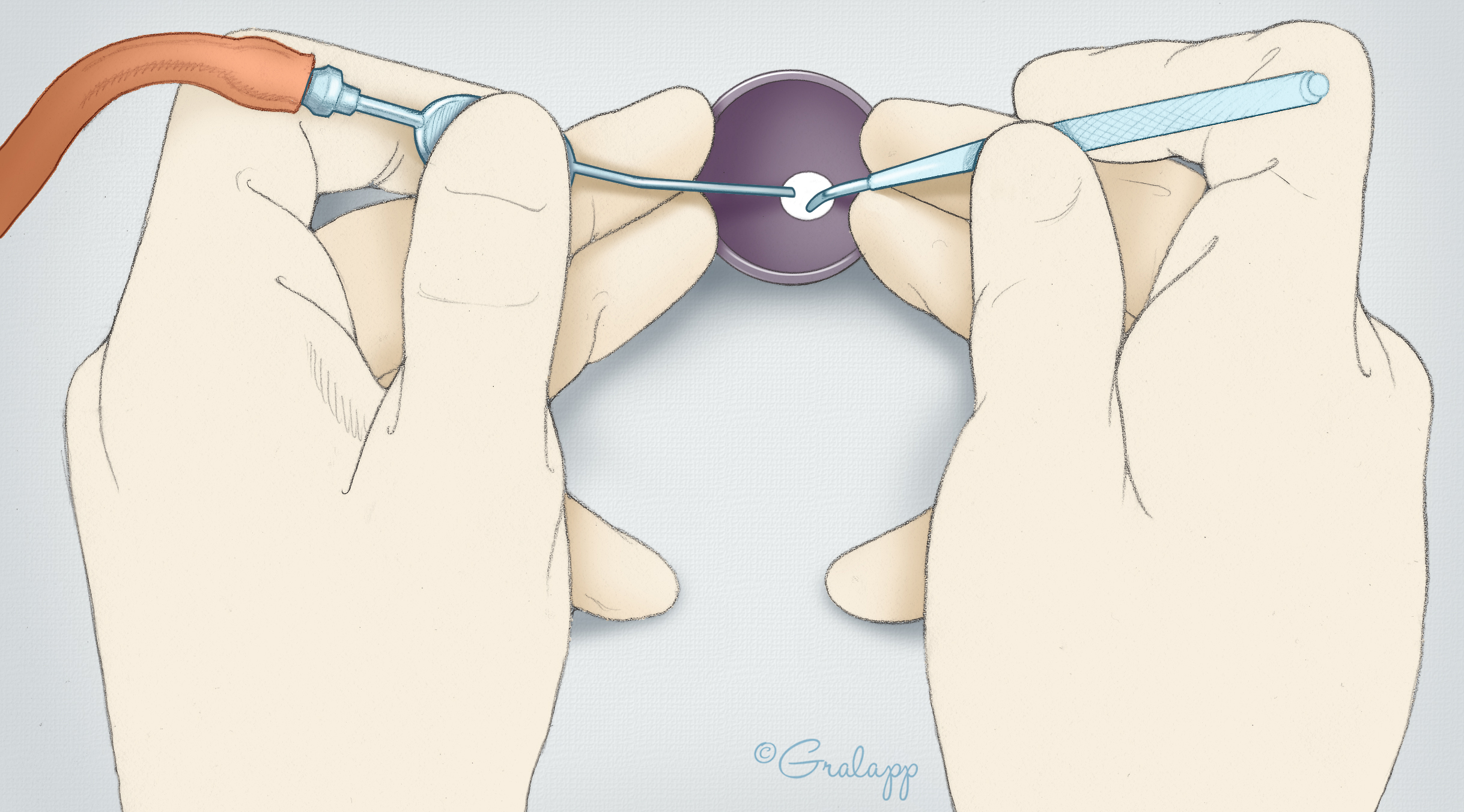 Placement of the surgeon’s hands during transcanal microsurgery. The third and fourth fingers of each hand stabilize the speculum. Note that the microinstrument (right hand) and suction (left hand) are held in a manner to both optimize stability and to enable binocular viewing. Some surgeons use a speculum holder to enhance stability, but it is best for all ear surgeons to be trained without use of a holder as such devices may not be available in all settings.