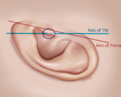 The pinna tilts posterior about 15 degrees with respect to the axis of the malleus.